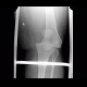 Dislocation of knee: X-ray - Plain radiograph